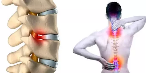 Позвоночные грыжи и протрузии!